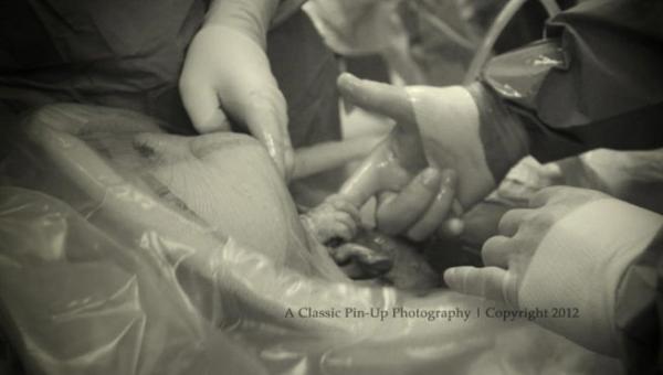 ¡Increíble! Esta bebé se aferró al dedo del cirujano en el vientre de su madre