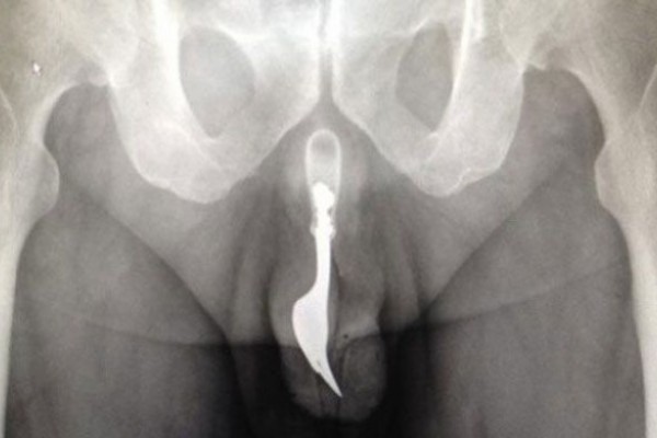 Se metió un tenedor por el pene… ¡Al hospital! (Foto)