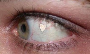 Moda arriesgada: Implantes de joyas en los ojos