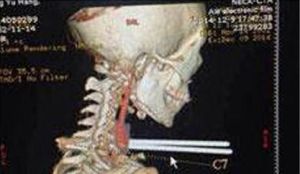 Niño de 12 años sobrevive tras clavarse los palillos chinos en la garganta