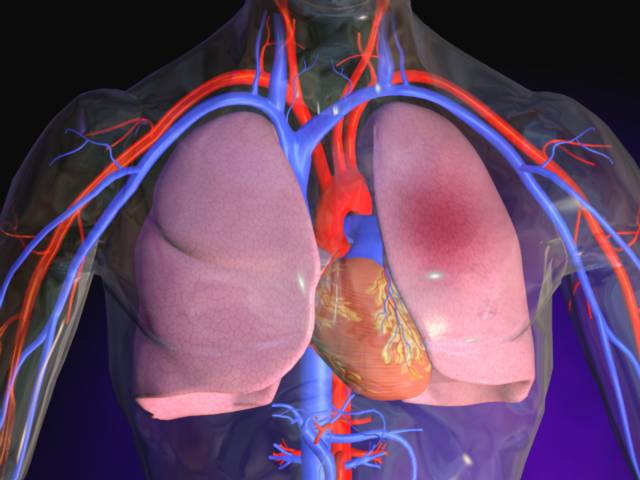 Embolia-pulmonar