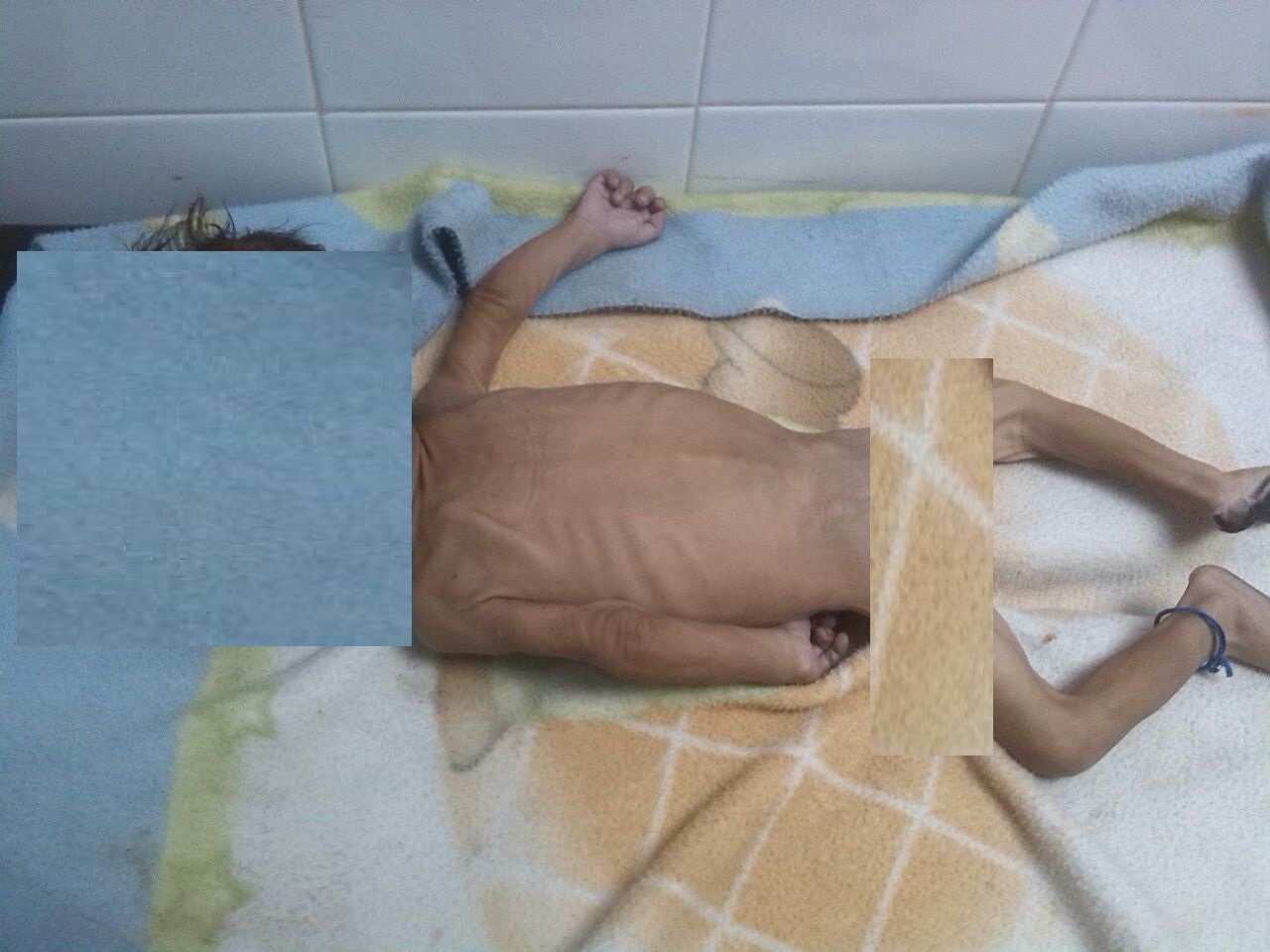 Muere lactante de seis meses por presunta desnutrición en el estado Aragua
