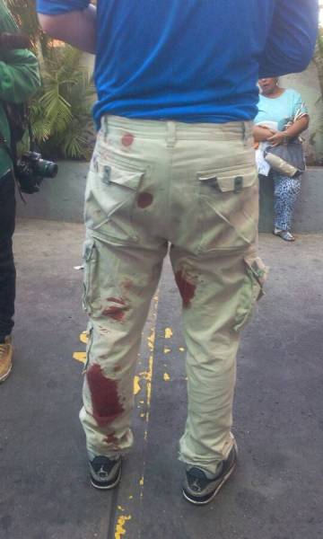El fotógrafo de La Patilla, Will Jiménez, recibió varias heridas de perdigón (Foto: Régulo Gómez / LaPatilla)