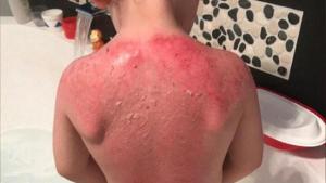 ¡Insólito! Protector solar de Peppa Pig le ocasiona quemaduras graves a niño de tres años