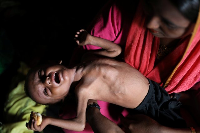 A Rohingya child cries on his mother's lap while suffering from severe malnutrition in the Balukhali camp in Cox's Bazar, Bangladesh October 5, 2017. Picture taken REUTERS/Mohammad Ponir Hossain
