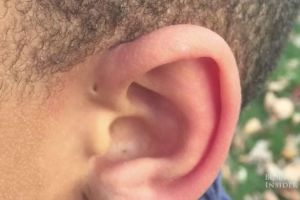 Por qué algunas personas nacen con pequeños agujeros en las orejas
