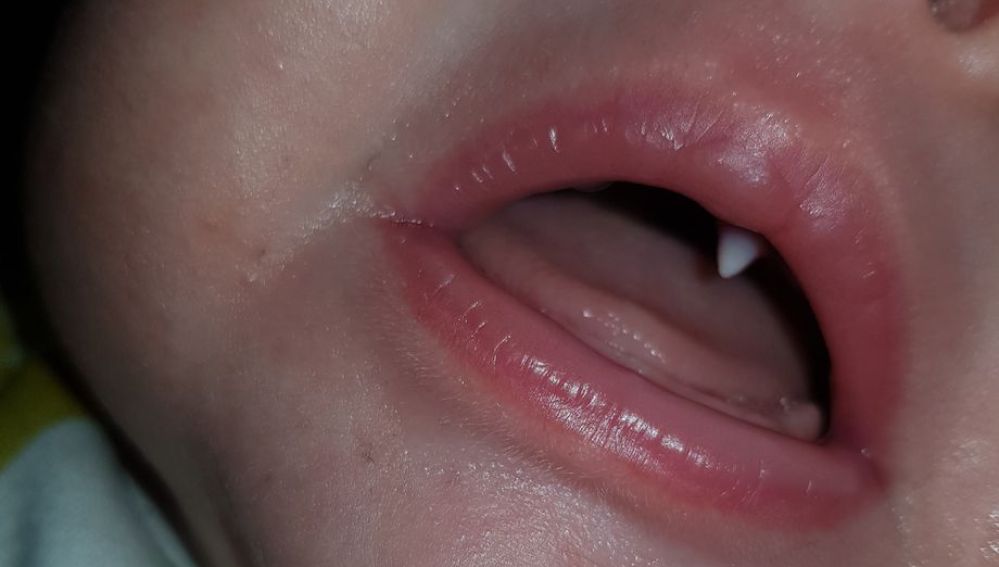 A un bebé de 11 semanas le creció un colmillo durante la noche (fotos)