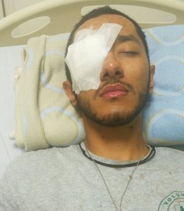 Estudiante de la UC perdió el ojo por un disparo con una metra en el Fuerte Paramacay (FOTO)