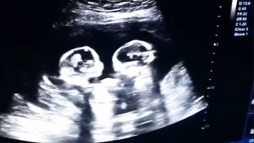 EN VIDEO: Dos gemelas pelean en el vientre de su madre y son grabadas durante ecografía