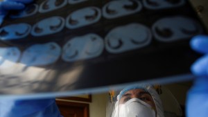 Realizan primer trasplante doble de pulmón a paciente que contrajo coronavirus en Latinoamérica