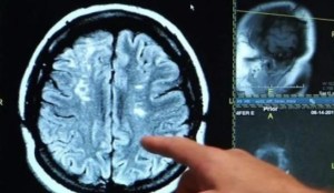 Científicos descubren causas del avance del mal de Alzheimer en el cerebro