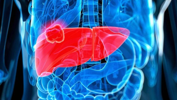 Por qué los médicos dicen que hay que prestarle más atención al hígado graso