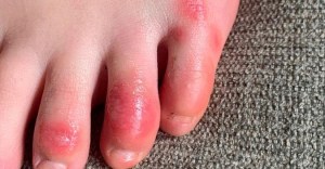 Lesiones en manos y pies podrían ser un efecto de respuesta inmune al coronavirus
