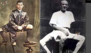 El inusual caso de Francesco Lentini, el hombre que tuvo dos genitales y tres piernas