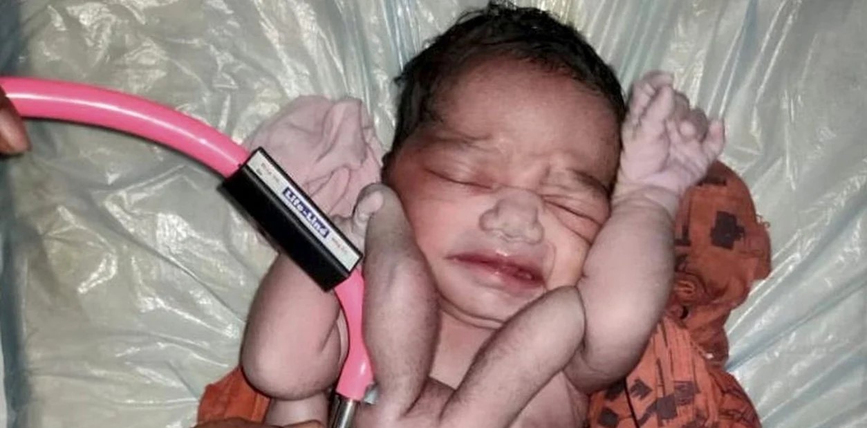 Dio a luz a un bebé con cuatro piernas y cuatro brazos en India: afirman que es la “reencarnación de Dios” (FOTOS)