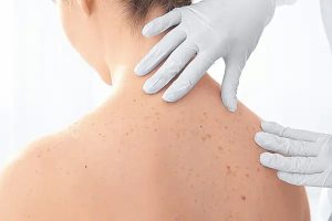 Adelántate al cáncer de piel: claves para detectar los lunares malignos