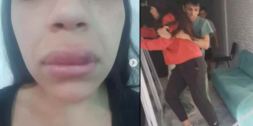 Le inyectaron sustancia en los labios que le causó alergia, reclamó y la sacaron a golpes