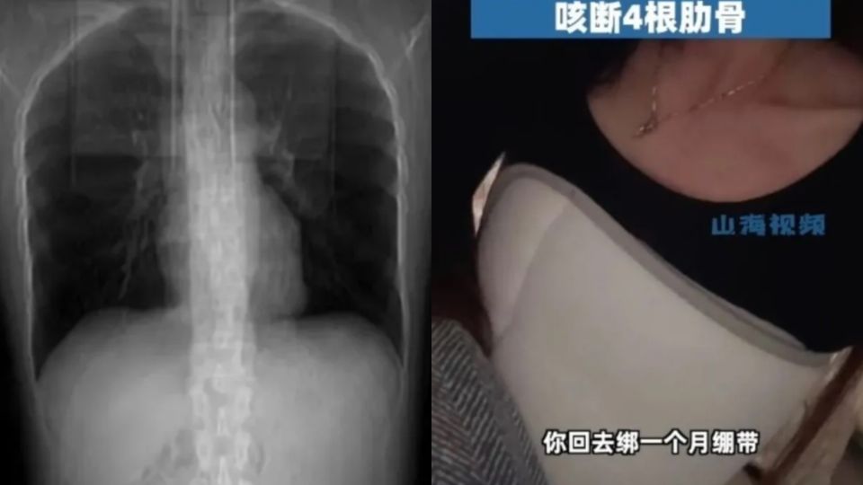 Mujer estornuda después de comer picante y se rompe cuatro costillas: la razón la dejó en shock