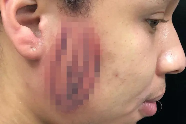 Un mal tatuaje en Washington: Cómo el diseño de una vagina en su cara lo arruinó por completo
