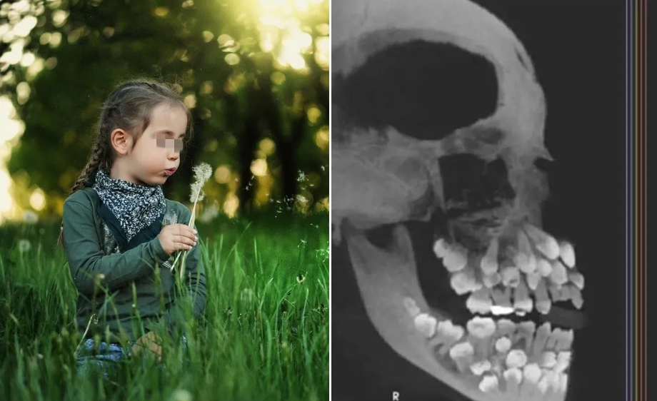 “Niña piraña”: El insólito caso de una pequeña con 81 dientes se hace VIRAL