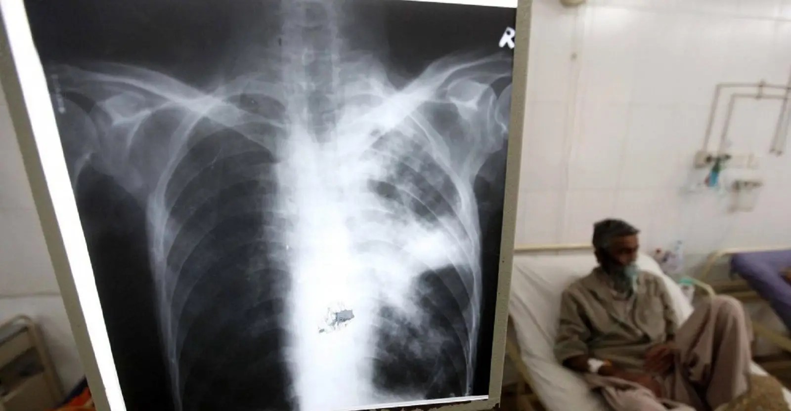 ¿Cuál es el panorama de la tuberculosis en Venezuela?