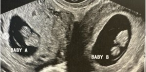 Sorpresa en Alabama: Mujer tiene doble útero y está embarazada en ambos